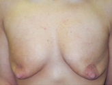 Patient # 24970 Before Photo # 1